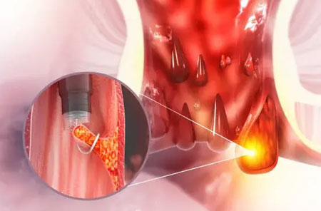 Laser Treatment for Piles