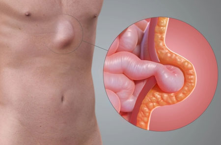 Hernia Surgery
