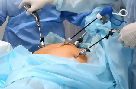 Laparoscopic Surgery
