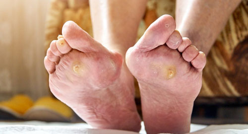 Diabetic Foot Treatment with Reconstruction