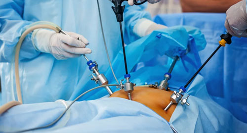 Laparoscopic Surgeries
