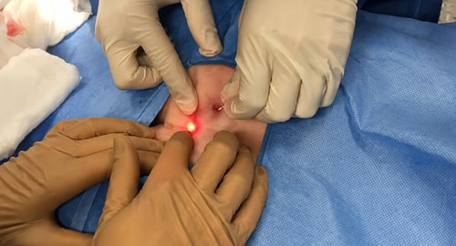 Laser Surgery for Piles Fissure Fistula Pilonidal Sinus