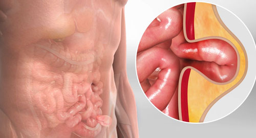 Hernia Surgery