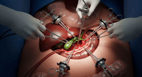 Cholecystectomy Gallbladder Surgery