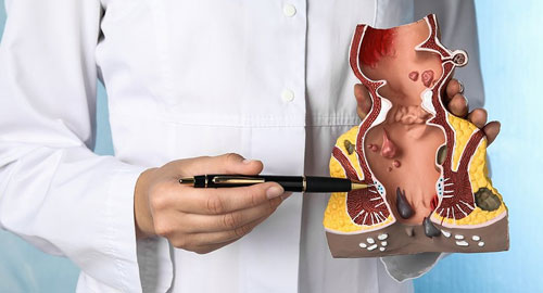 Piles Treatment