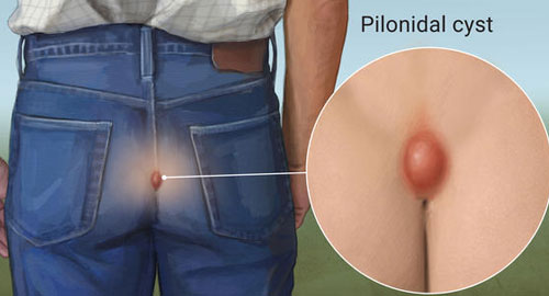 Pilonidal Sinus Treatment